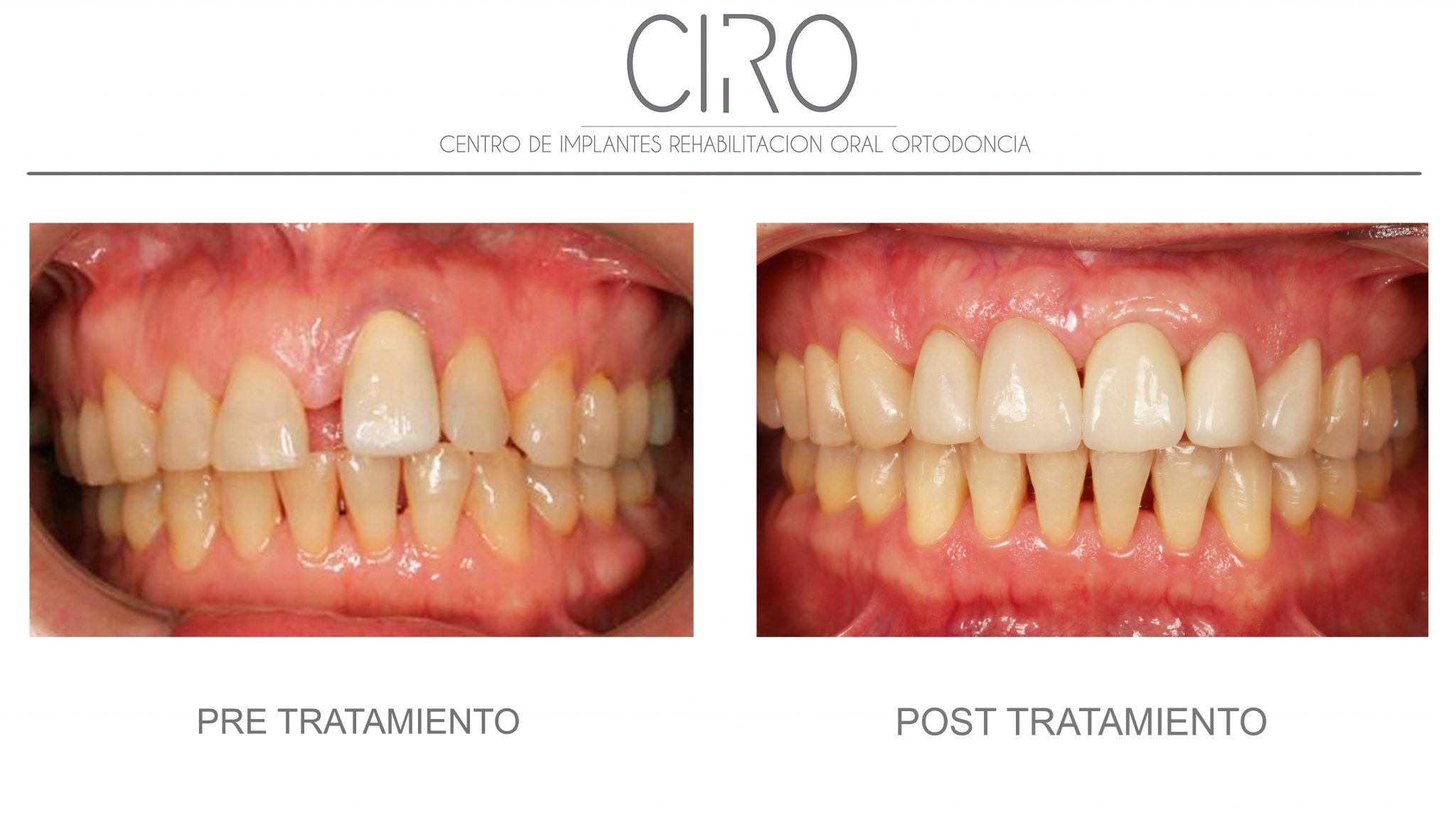 Caso clínico de implantes