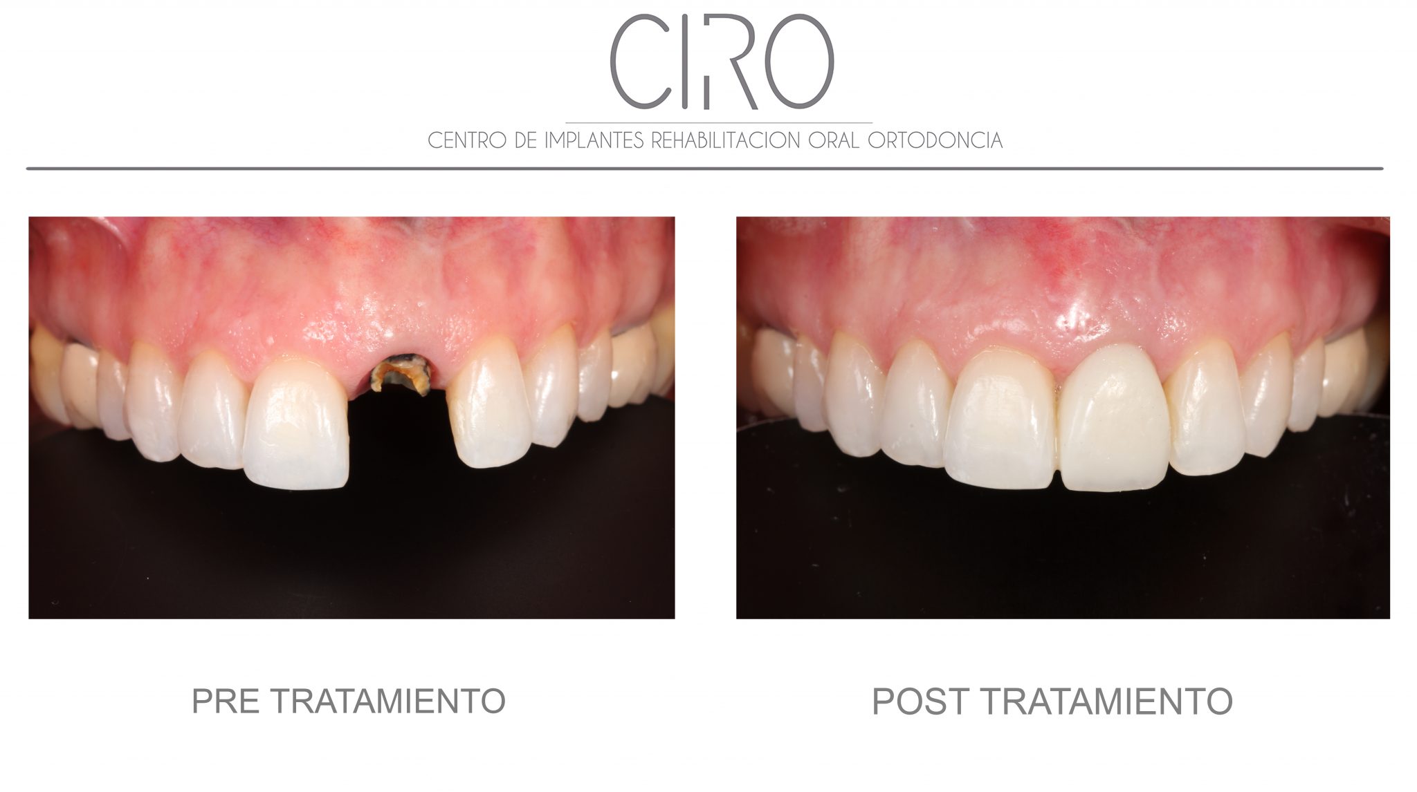 Casos clínicos reales de estética dental e implantes en Clínica CIRO Madrid resultados antes y después