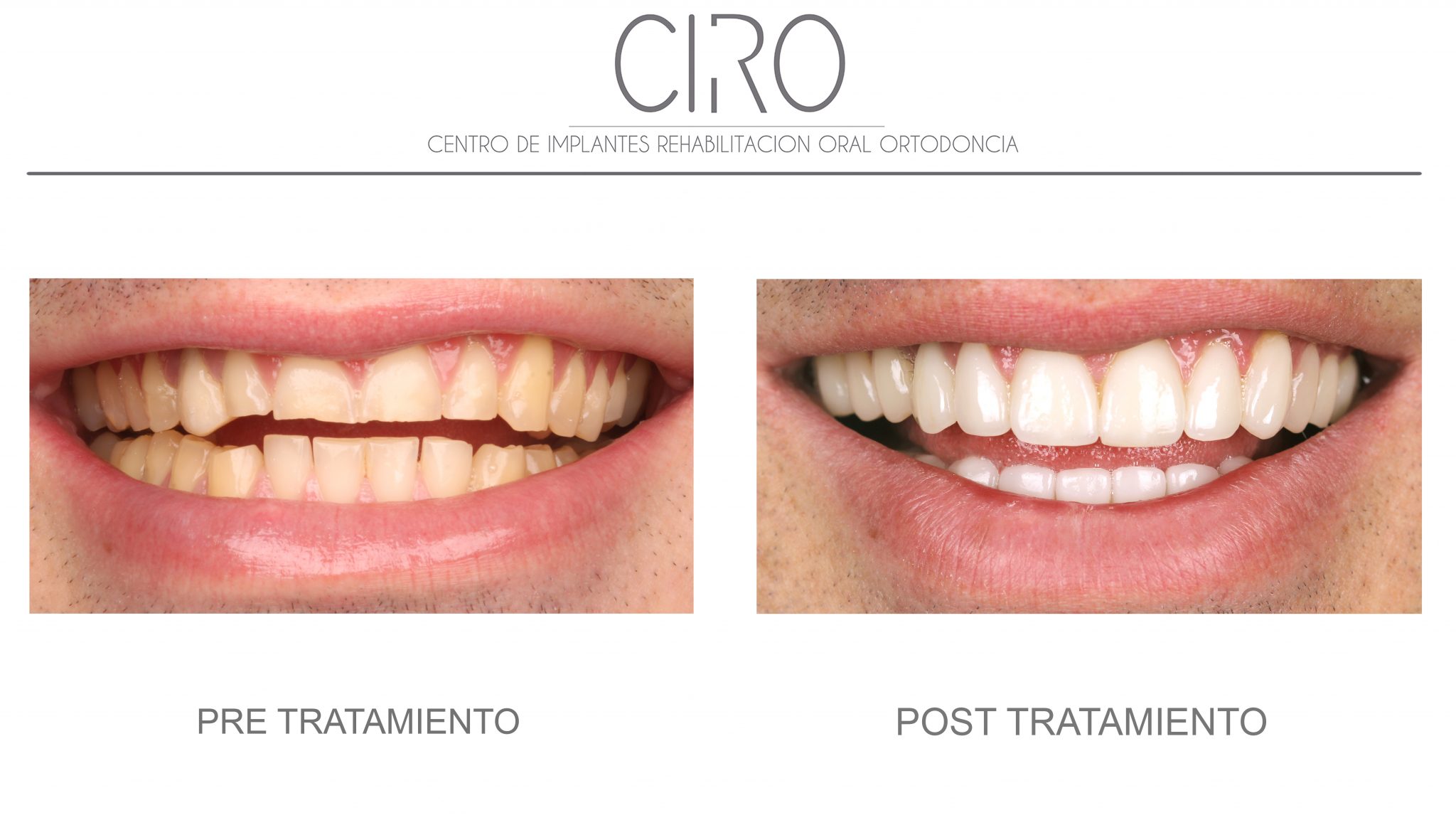 Caso clínico de estética dental y blanqueamiento en CIRO La Moraleja