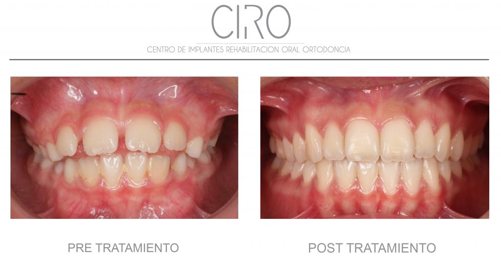 Caso clínico de ortodoncia