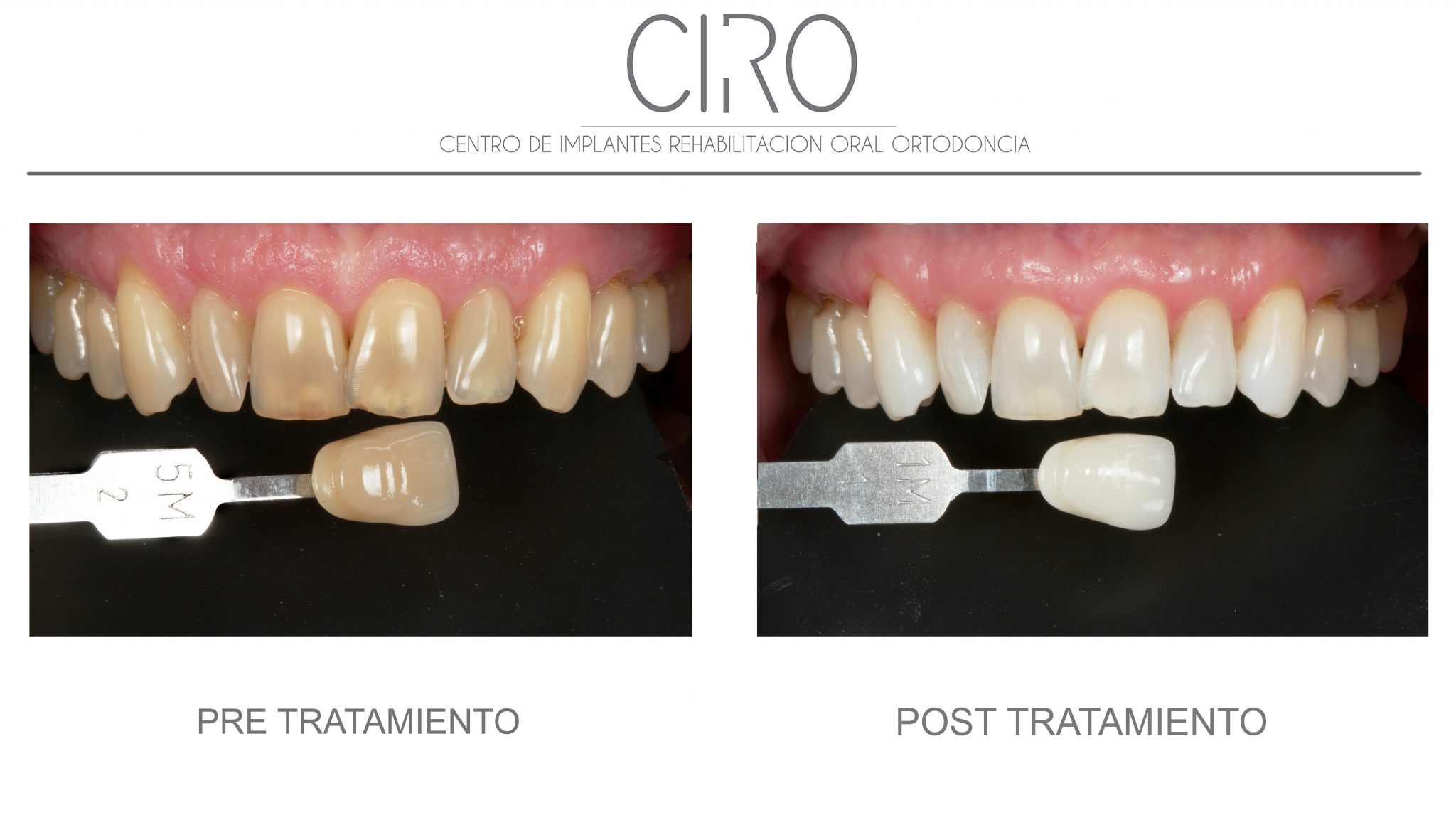 Caso de blanqueamiento dental