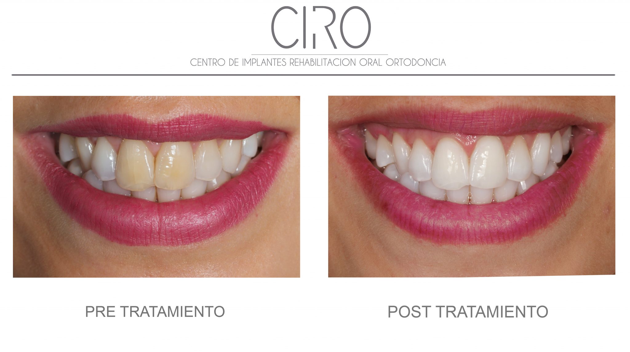 Caso de blanqueamiento dental