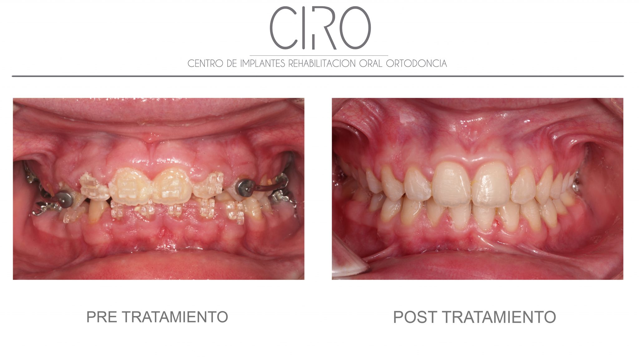 Caso periodoncia