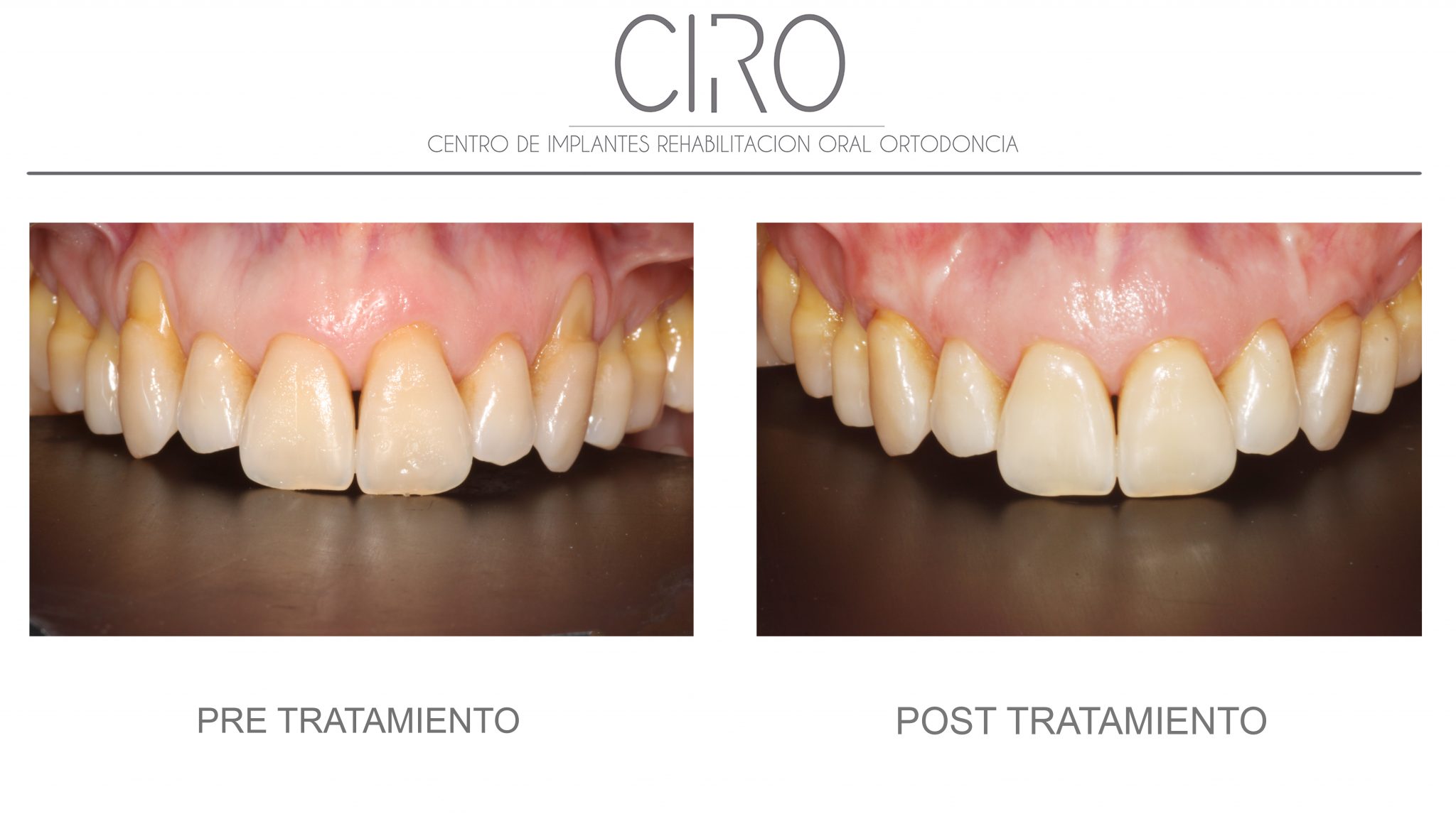 Caso periodoncia