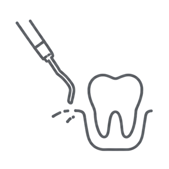 Tratamiento periodontal con raspado y eliminación de sarro