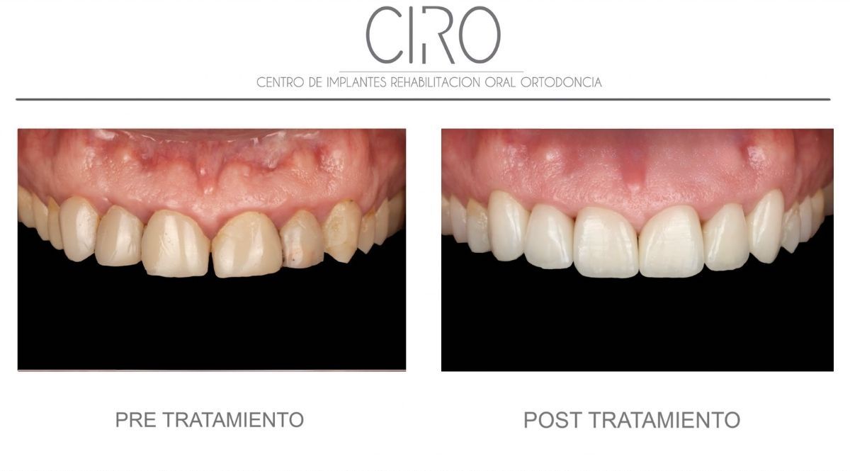 Antes y después de carillas de porcelana en sector anterior, tratamiento de estética dental en Clínica CIRO La Moraleja Alcobendas