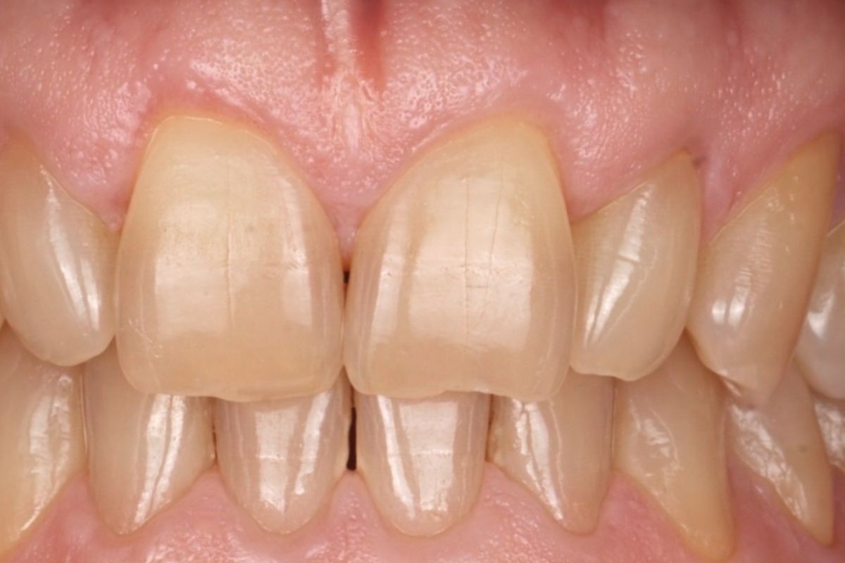 Pigmentación amarillenta en dientes y alteración del color dental en Clínica Ciro La Moraleja