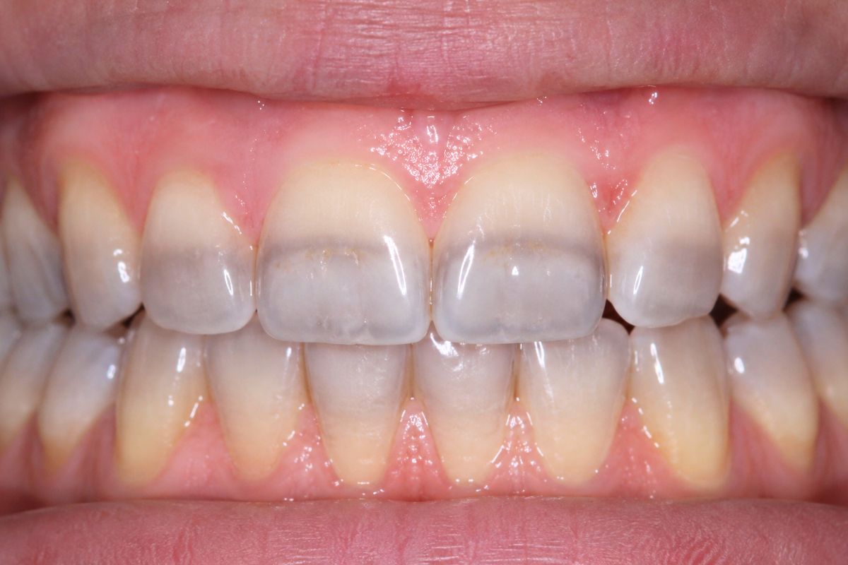 Manchas grises en dientes compatibles con tinción por tetraciclinas tratadas en Clínica Ciro La Moraleja