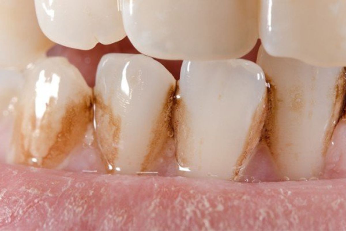 Paciente con manchas marrones en los dientes por tinción dental evaluadas en Clínica Ciro La Moraleja