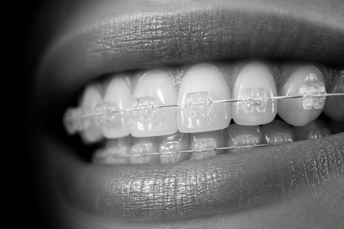 Brackets estéticos transparentes en Clínica CIRO Alcobendas, ortodoncia discreta en La Moraleja, norte de Madrid